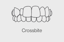 crossbite