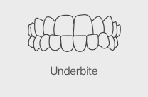 underbite